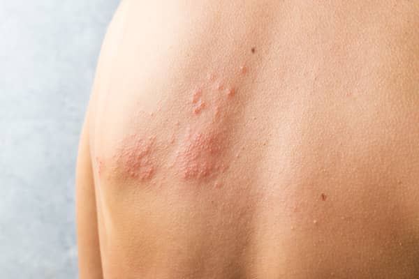 You should get advice from 111 as soon as possible if you think you have shingles
