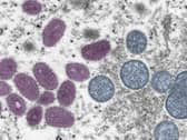 Monkeypox pathogen. Credit: UKHS