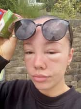 A Stockport woman’s eyes swelled over two days after she experienced sun poisoning.