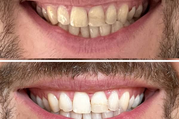 MySweetSmile claims to help put the white back in anyone's smile