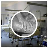 The WHO has declared a global health emergency over a mpox outbreak. (Photo: Pixabay, CDC/Getty Images)