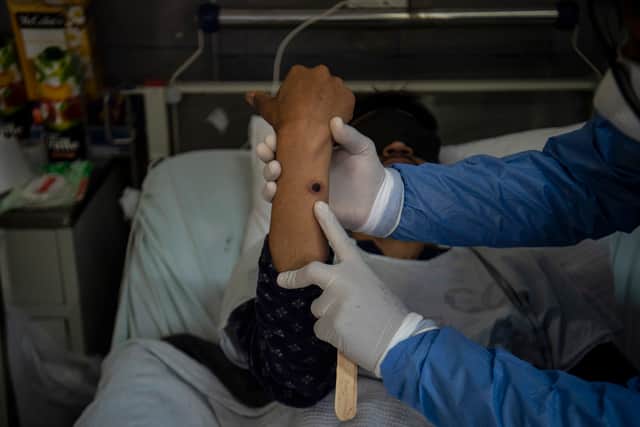 A doctor checks on a patient with sores caused by a mpox infection. (Photo: ERNESTO BENAVIDES/AFP via Getty Images)