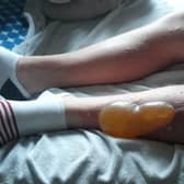 Jack's legs were severely burned.