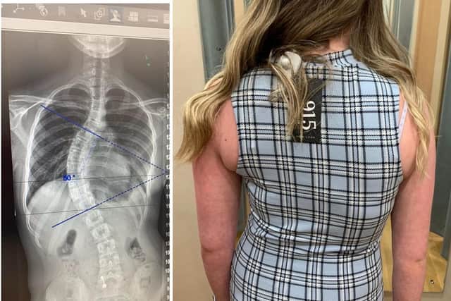 Scoliosis is a sideways curvature of the spine.