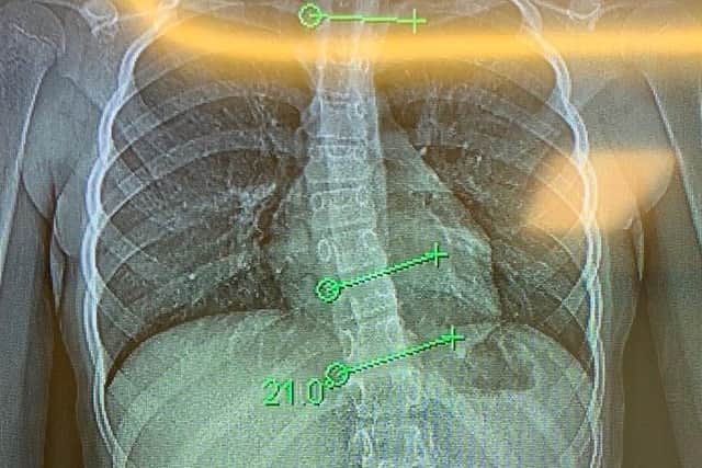 X-ray showing the degree of curvature on Megan's spine.