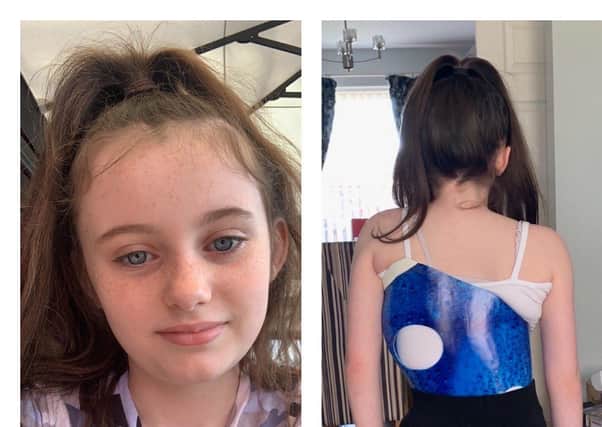Carrick schoolgirl Megan Scott (10) was diagnosed with scoliosis after her sister Emily underwent treatment for the same condition.