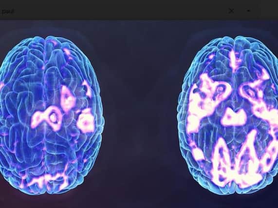 Brain activity scans. Left: A person suffering from depression. Right: After TMS treatment.