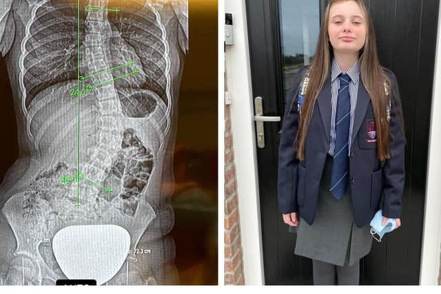 The family of Megan Scott are fundraising for the Larne Grammar pupil to undergo spinal surgery in Turkey.