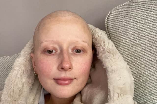 Abbie after she lost her hair due to chemo treatment. Pic credit: Teenage Cancer Trust
