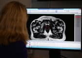 The scan of a patient diagnosed with prostate cancer