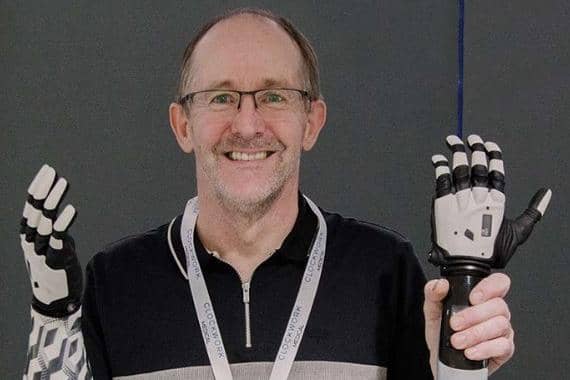 Local man Stephen Lowry said he can now do everything he needs with his new AI hand.