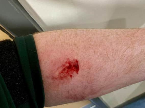 PSNI picture of injury allegedly sustained in attack.