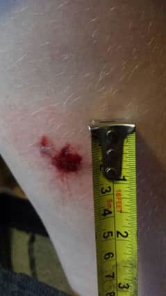 The bite mark the dog left on 13-year-old Charlie Ferguson's right leg after the attack.