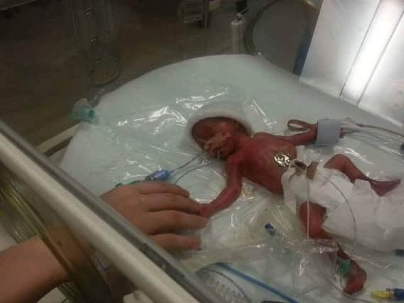 One of the twins who were born 15 weeks premature. inbm9-16