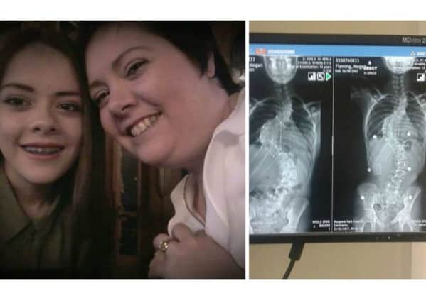 Megan Fleming (14) with mum, Karen. Right: An X-ray of Megan's spine