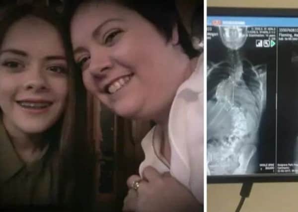 Megan Fleming and her mum, Karen. Right: an X-ray of Megan's spine.